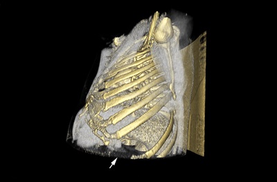 Three-dimensional CT scan demonstrating a wide left-sided gap between the 9th and 10th ribs.